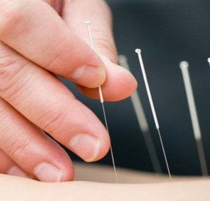 ACUPUNCTURE TREATMENT